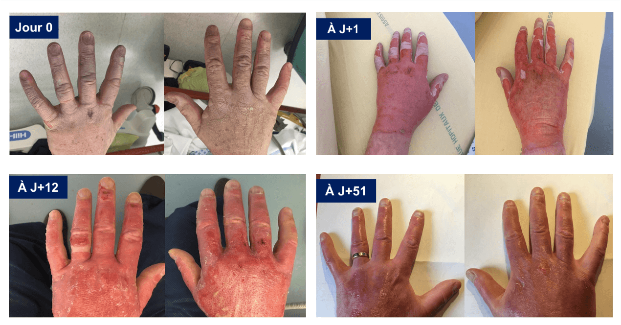 court-circuit sans gants isolants short circuit without PPE — no insulating gloves